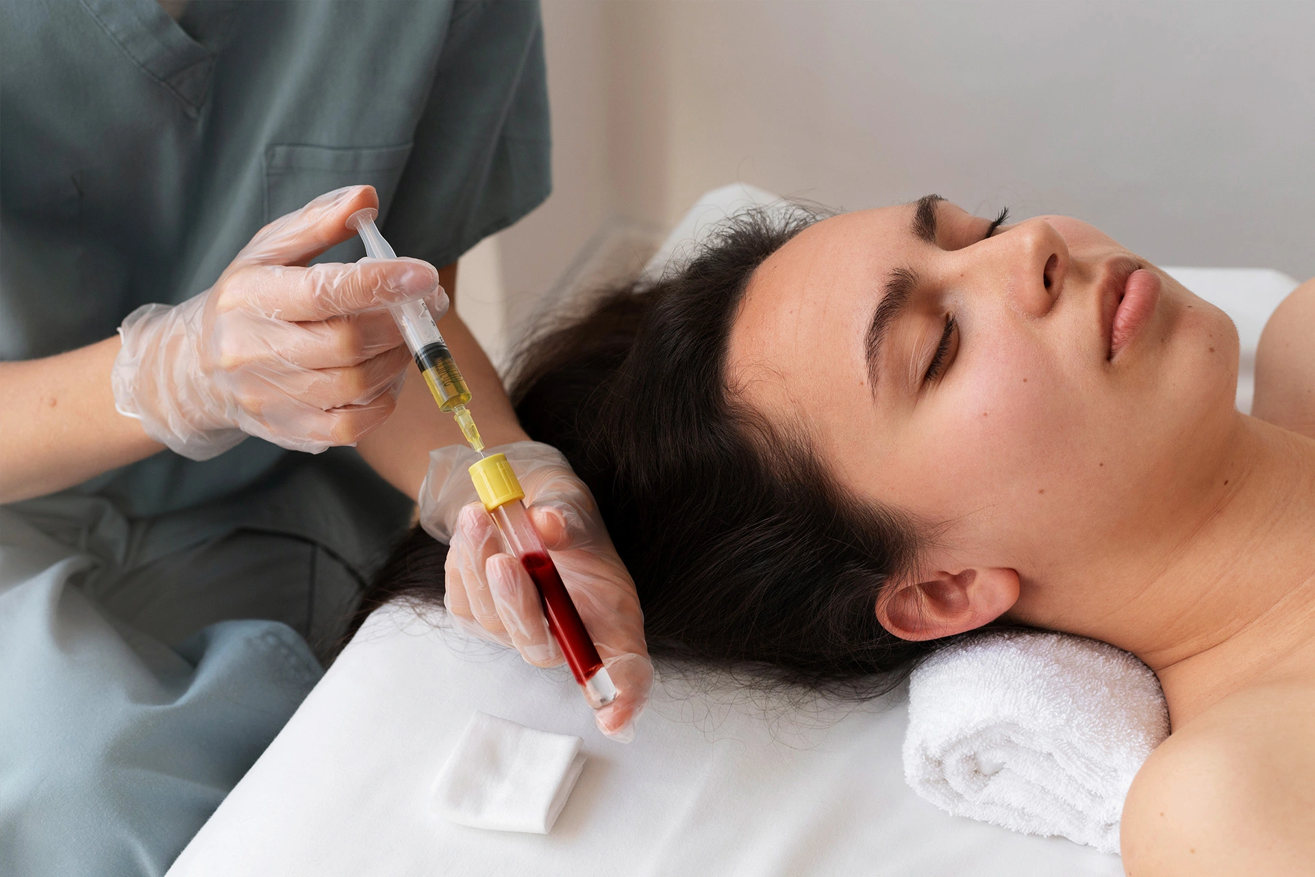 Microneedling with PRP